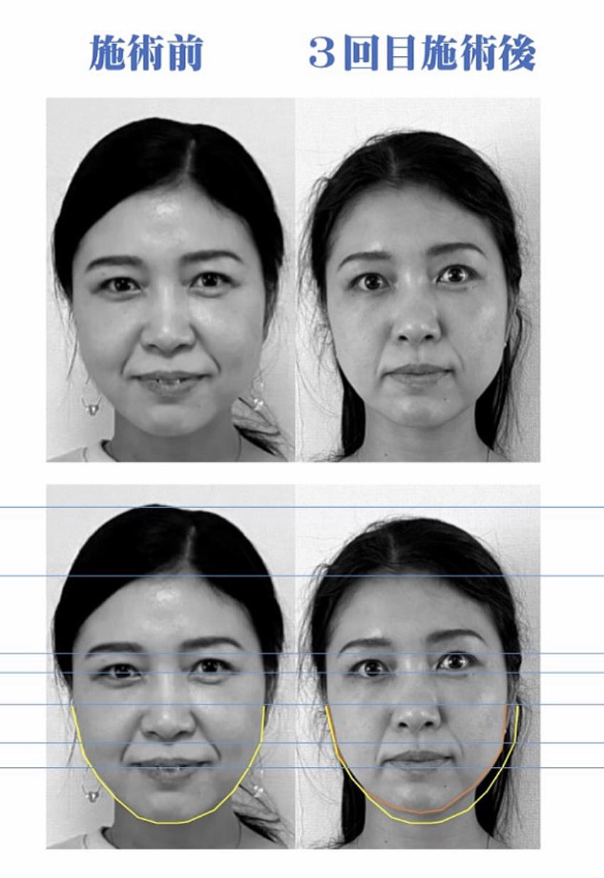 名古屋の美容鍼症例3回目施術後 名古屋の美容鍼で40代女性のほうれい線とフェイスラインが改善した3回目施術後の症例写真