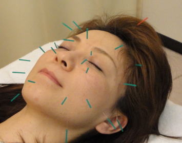 名古屋市東区の美容鍼|休息治療院の美容鍼施術風景 名古屋市東区の鍼灸院・休息治療院で行う美容鍼の施術風景。顔のむくみやたるみ、フェイスラインの悩みに対応した女性向け美容鍼です。